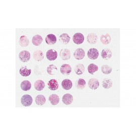 Breast invasive ductal carcinoma