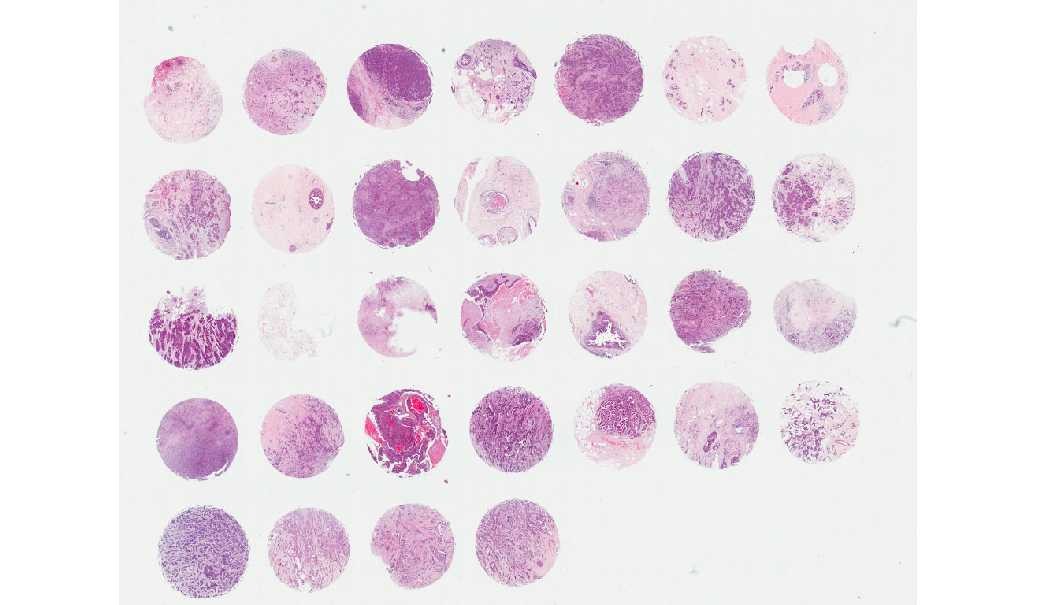 Breast invasive ductal carcinoma