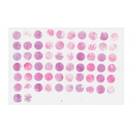 Breast invasive ductal carcinoma