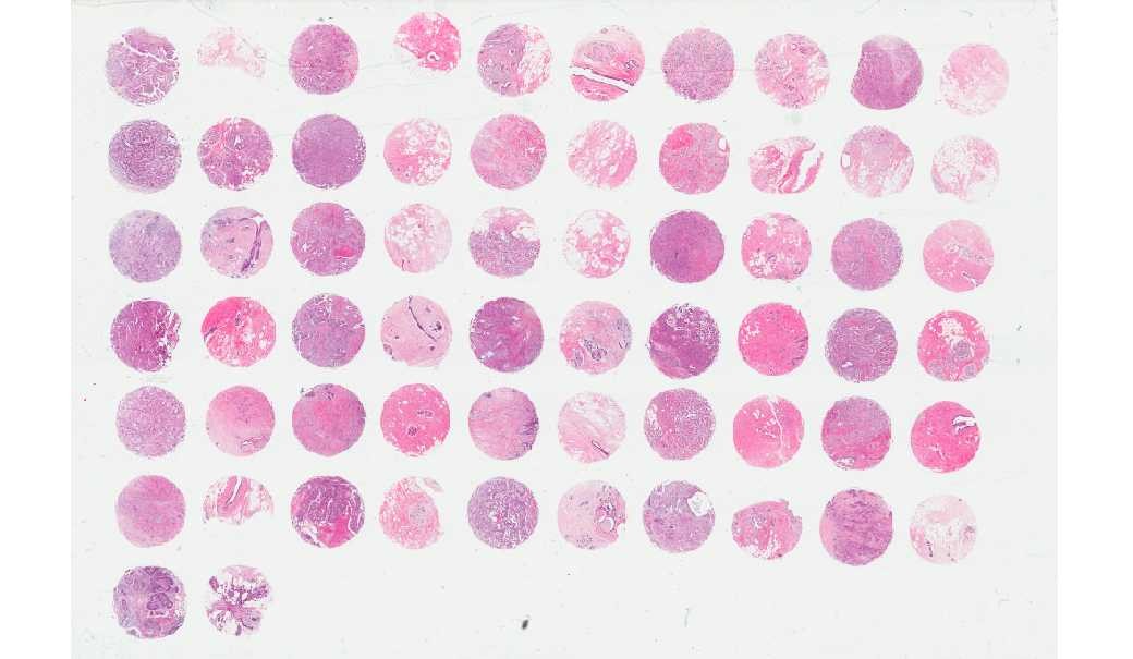 Breast invasive ductal carcinoma