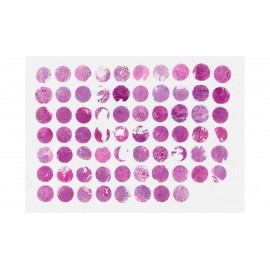 Breast invasive ductal carcinoma