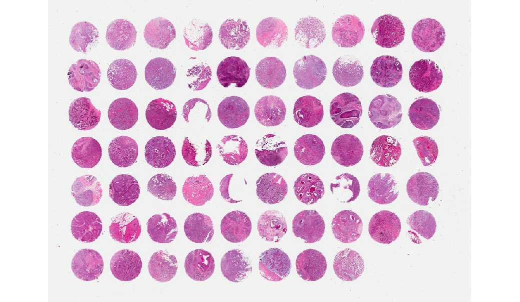 Breast invasive ductal carcinoma
