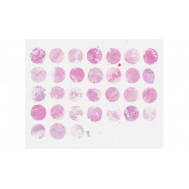 Breast invasive ductal carcinoma