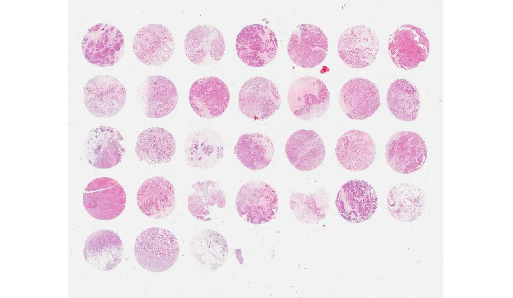 Breast invasive ductal carcinoma